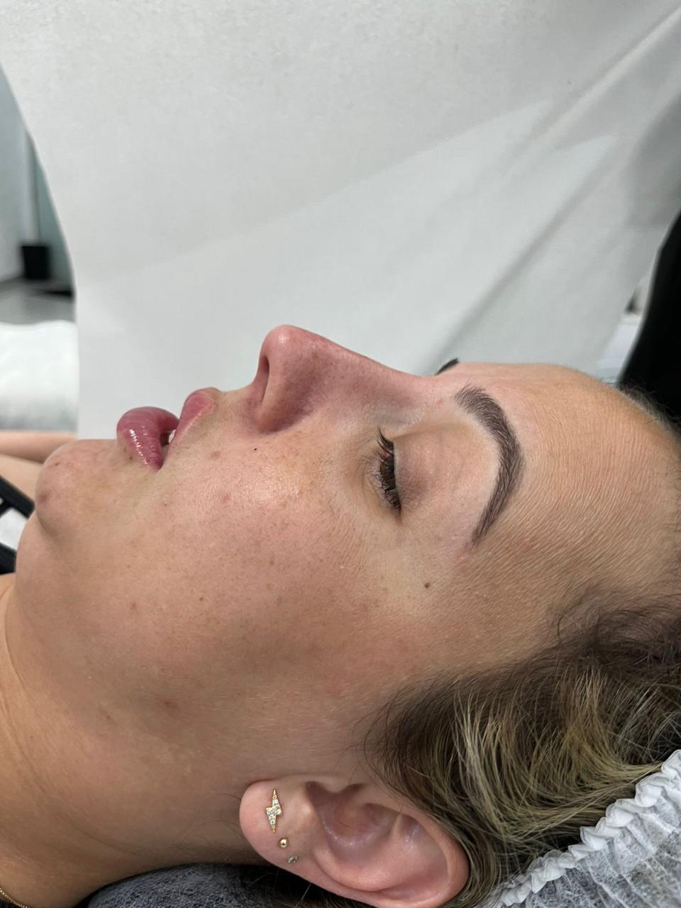 Resultado de procedimento 3